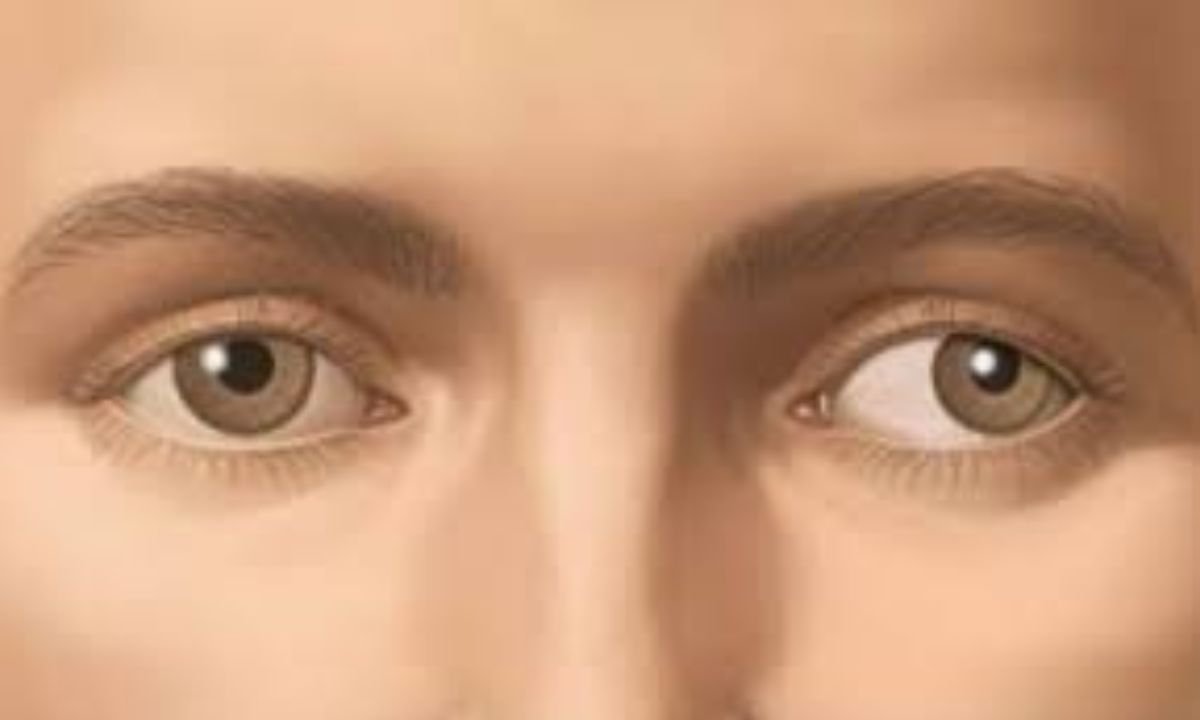 Strabismus in Adults