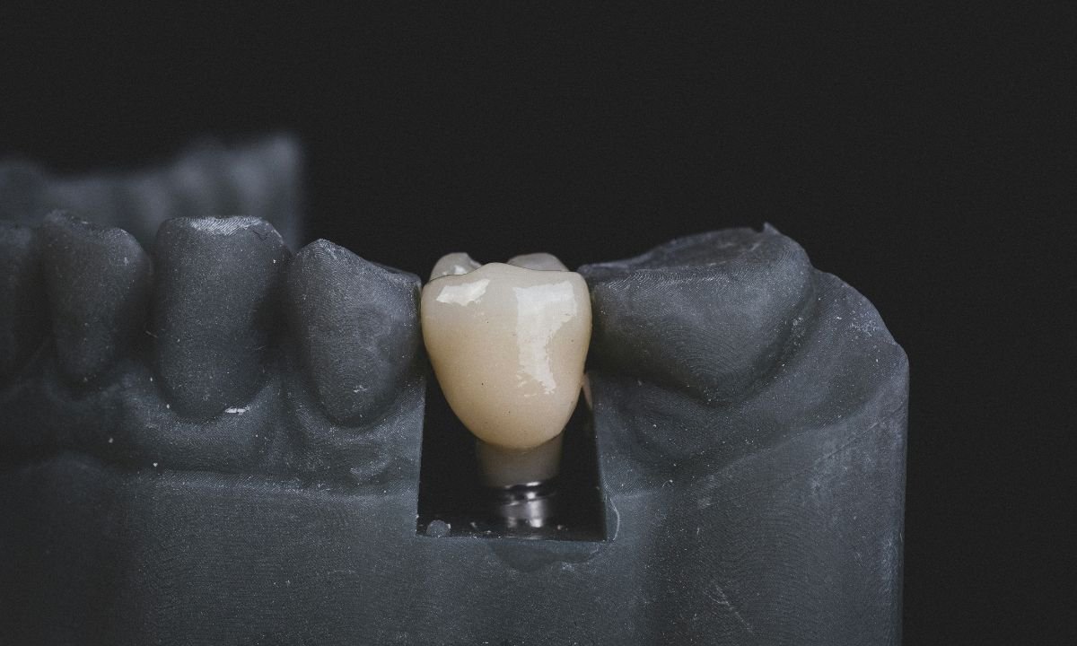 Dental Implants