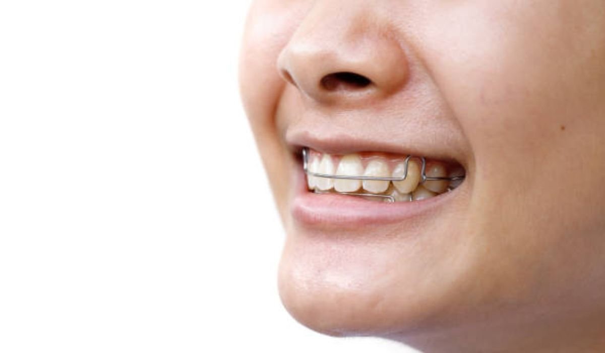 Aligning Teeth Without Metal