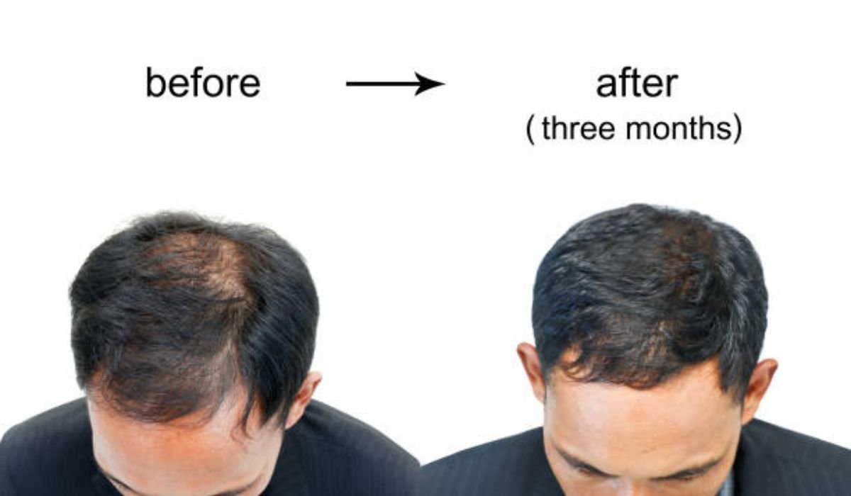 Hair Restoration Procedures