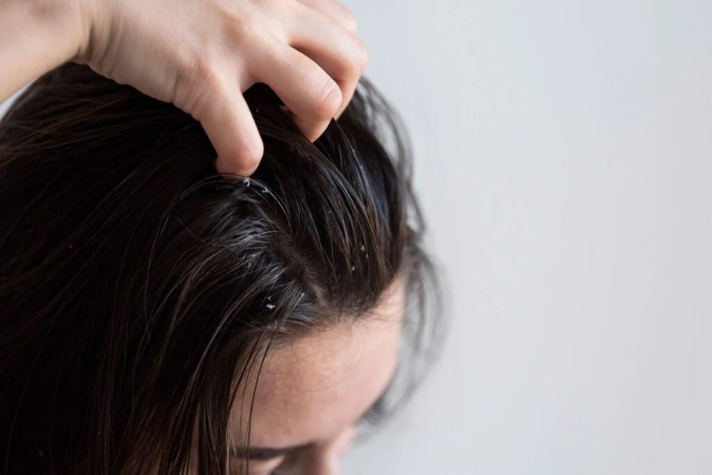 Understanding the Flaky Scalp Problem and How to Fix It